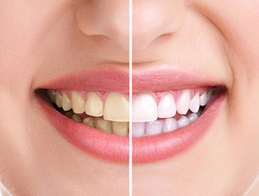 stomatologia estetyczna wybielanie zębów
